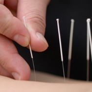 Acupuncture - Stuart Community
