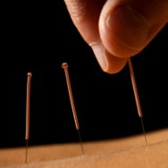 Acupuncture - Stuart Community
